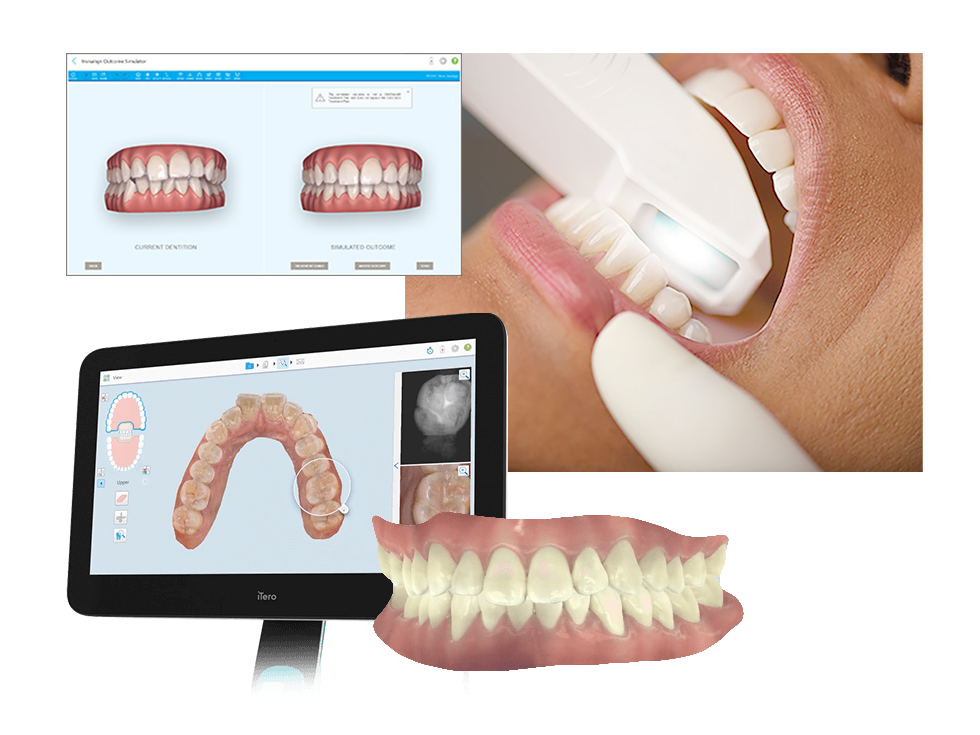口腔内光学スキャナ iTero(アイテロ)