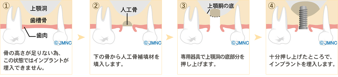 サイナスリフト法