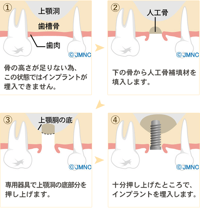 サイナスリフト法