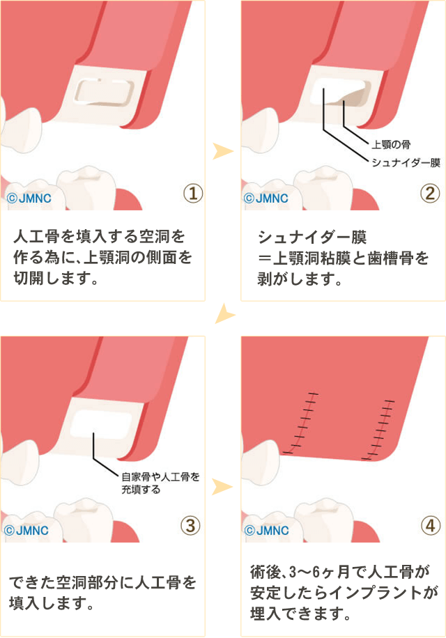 ソケットリフト法