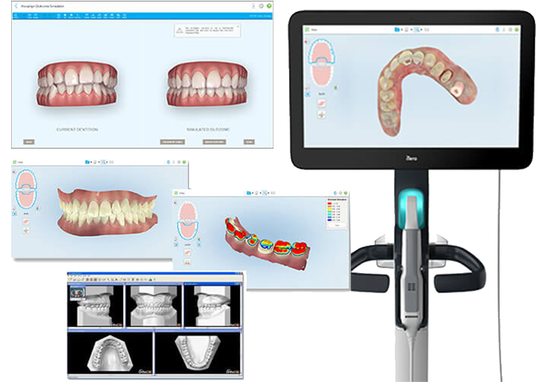 口腔内スキャナー「iTero」